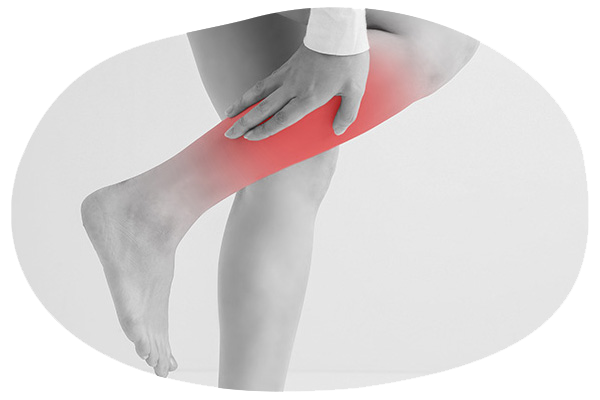 静脈瘤のイメージ