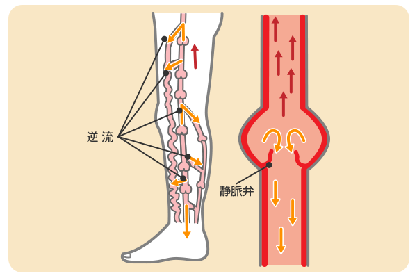 静脈弁がきちんと機能していない状態