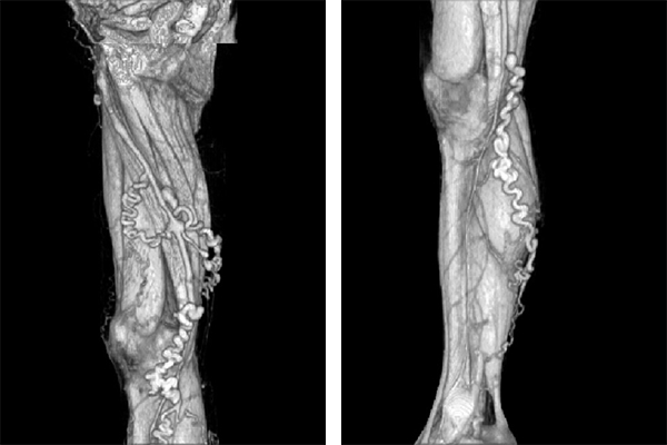 静脈瘤のCT画像