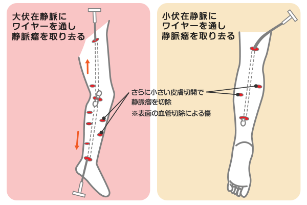 静脈瘤抜去術（ストリッピング）